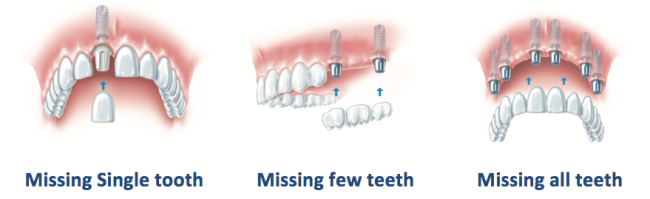 Dental-Implants